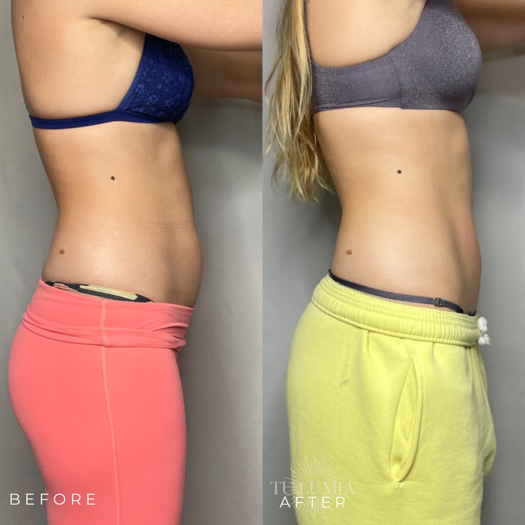 STOMACH SCULPT | 4 SESSIONS