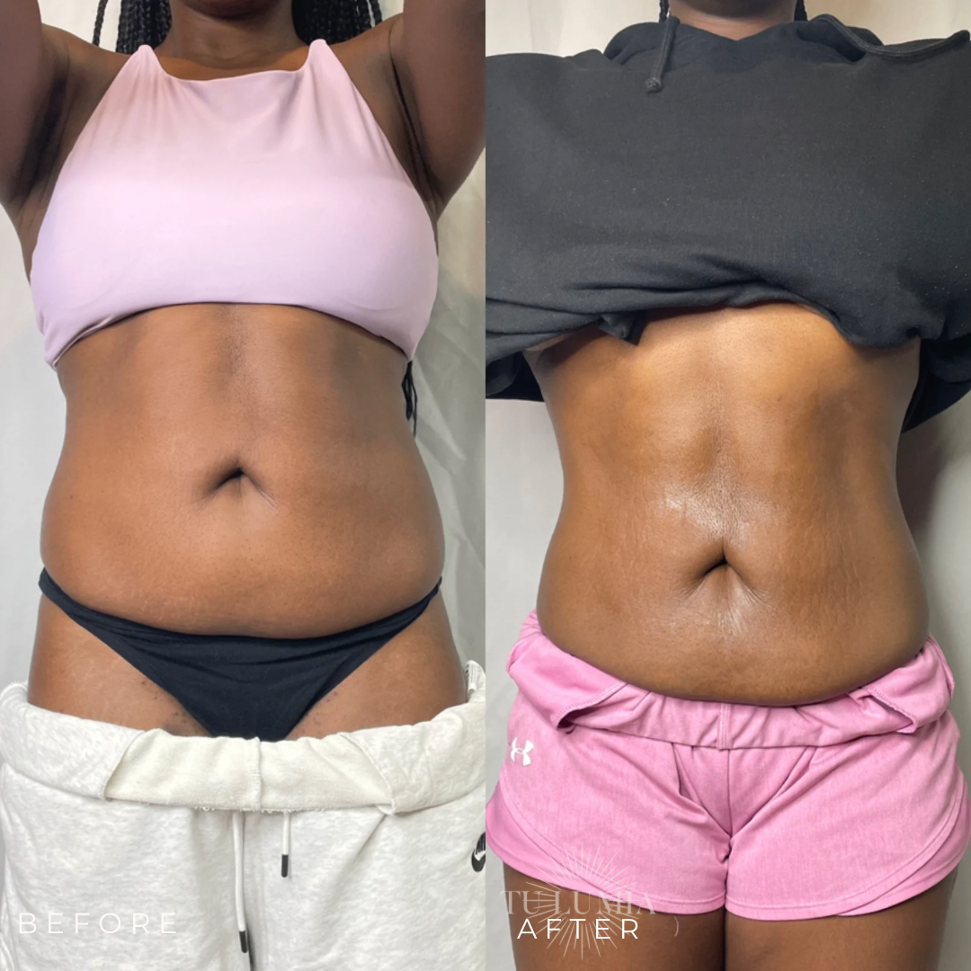 STOMACH SCULPT | 3 SESSIONS