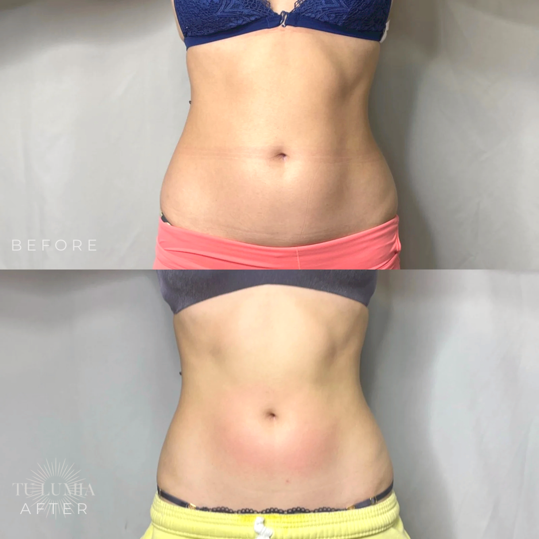 STOMACH SCULPT | 4 SESSIONS