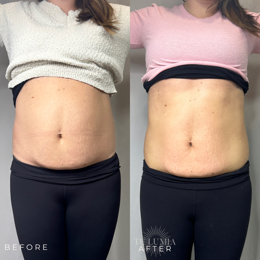 STOMACH SCULPT | 3 SESSIONS