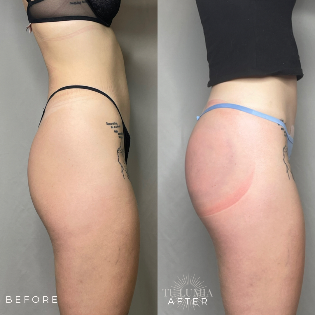 BOOTY SCULPT | 3 SESSIONS