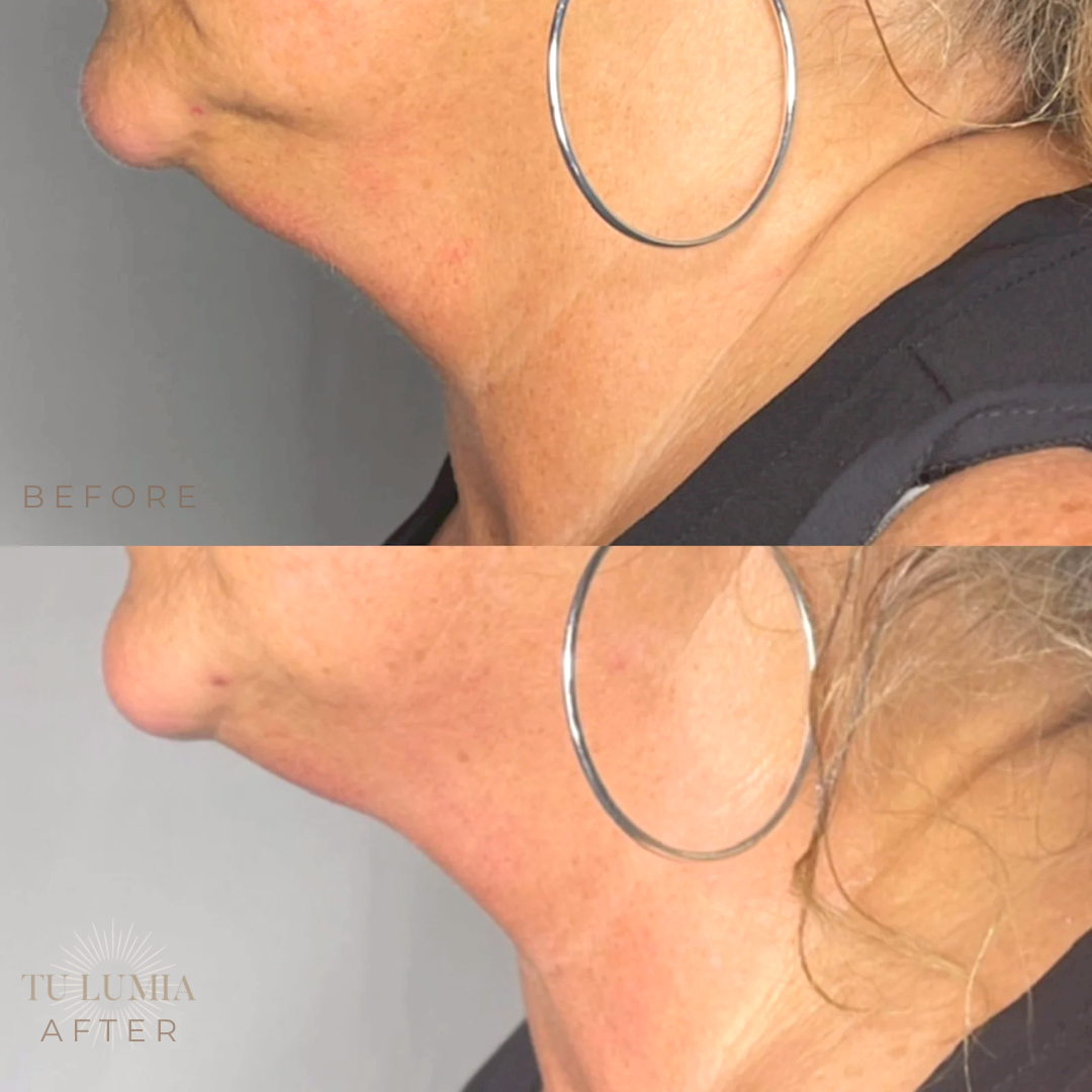 FACIAL SCULPT | 1 SESSIONS