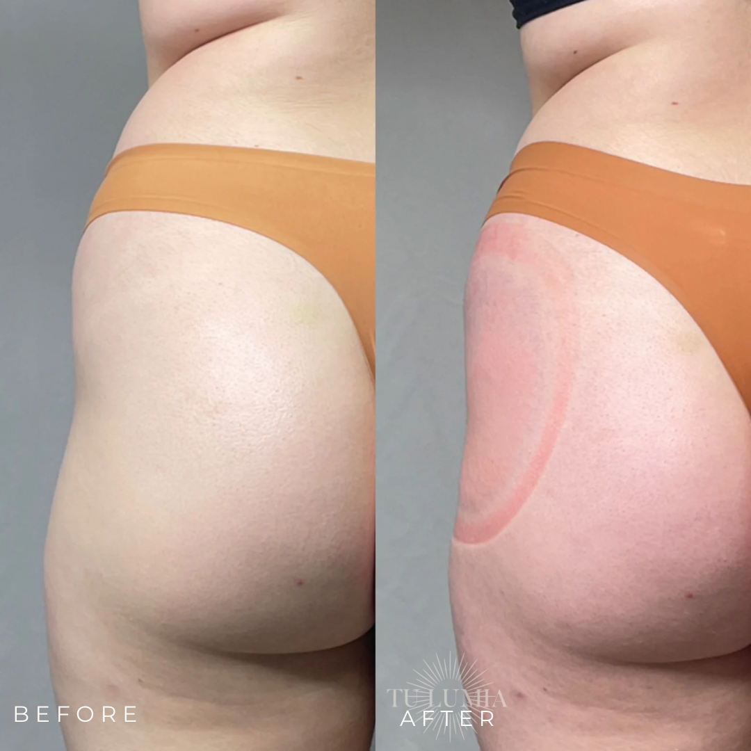 BOOTY SCULPT | 1 SESSIONS