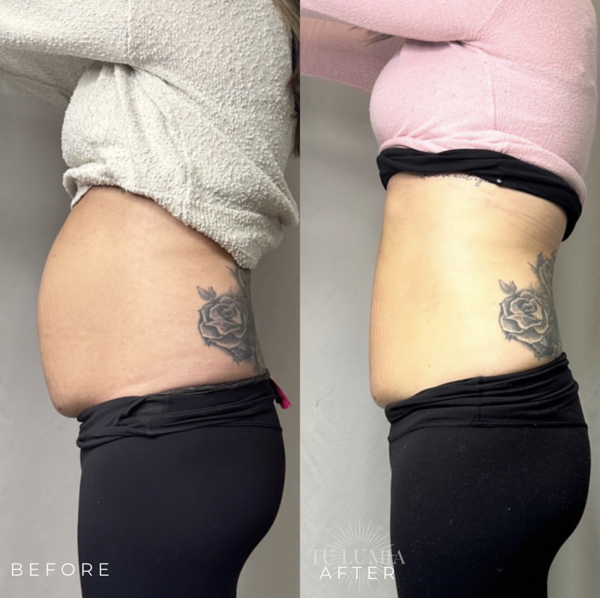 STOMACH SCULPT | 3 SESSIONS